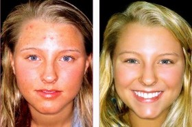 #Teen #Facial #Haxton #Skin #SkinCare #LosAltos #Celebrity #Teen #Facial #Haxton #Skin #SkinCare #LosAltos #Celebrity